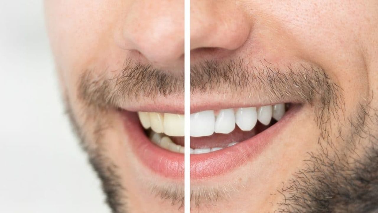 Performance of Professional Teeth Whitening Dry Strips: From Convenience to Confidence